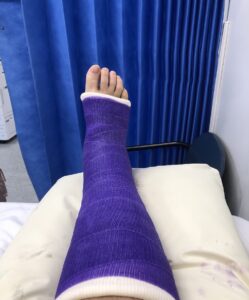 Purple cast from below toes to just below knee - apparently an ankle cast.